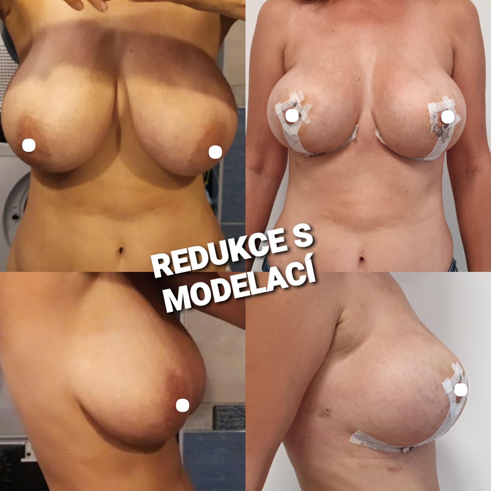 Redukce s modelací