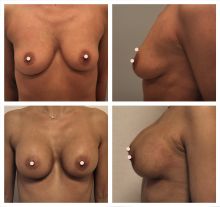 Augmentace - zvětšení prsou
