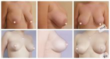 Redukční mammoplastika - zmenšení a modelace prsou