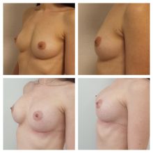 Augmetnace - zvětšení prsou